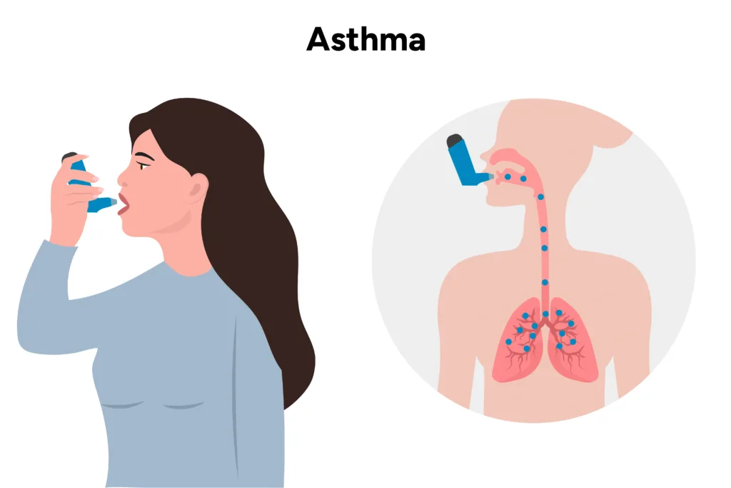 When Asthma Chest Pain Feels Like a Heart Problem