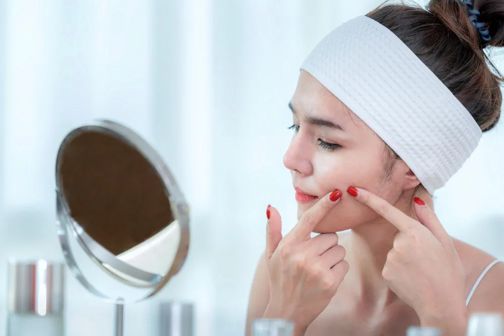 How to Get Rid of Acne Marks