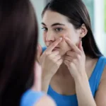 How to Get Rid of Acne Marks