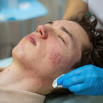 Cause Acne Breakouts